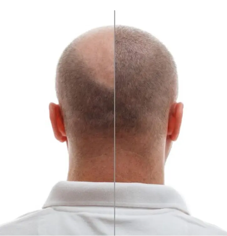 Comparativa de antes y después de micropigmentación capilar en la zona de la coronilla y posterior de la cabeza, mostrando un resultado de efecto rapado natural y denso - Guendalina Guzzo - Alma Design Care