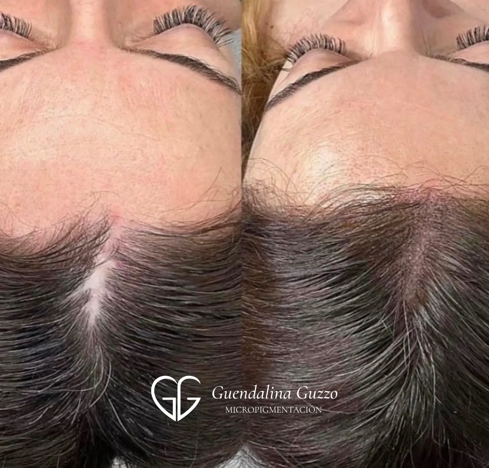 Resultado de micropigmentación capilar para densidad en mujer antes y después en Marbella por Guendalina Guzzo.