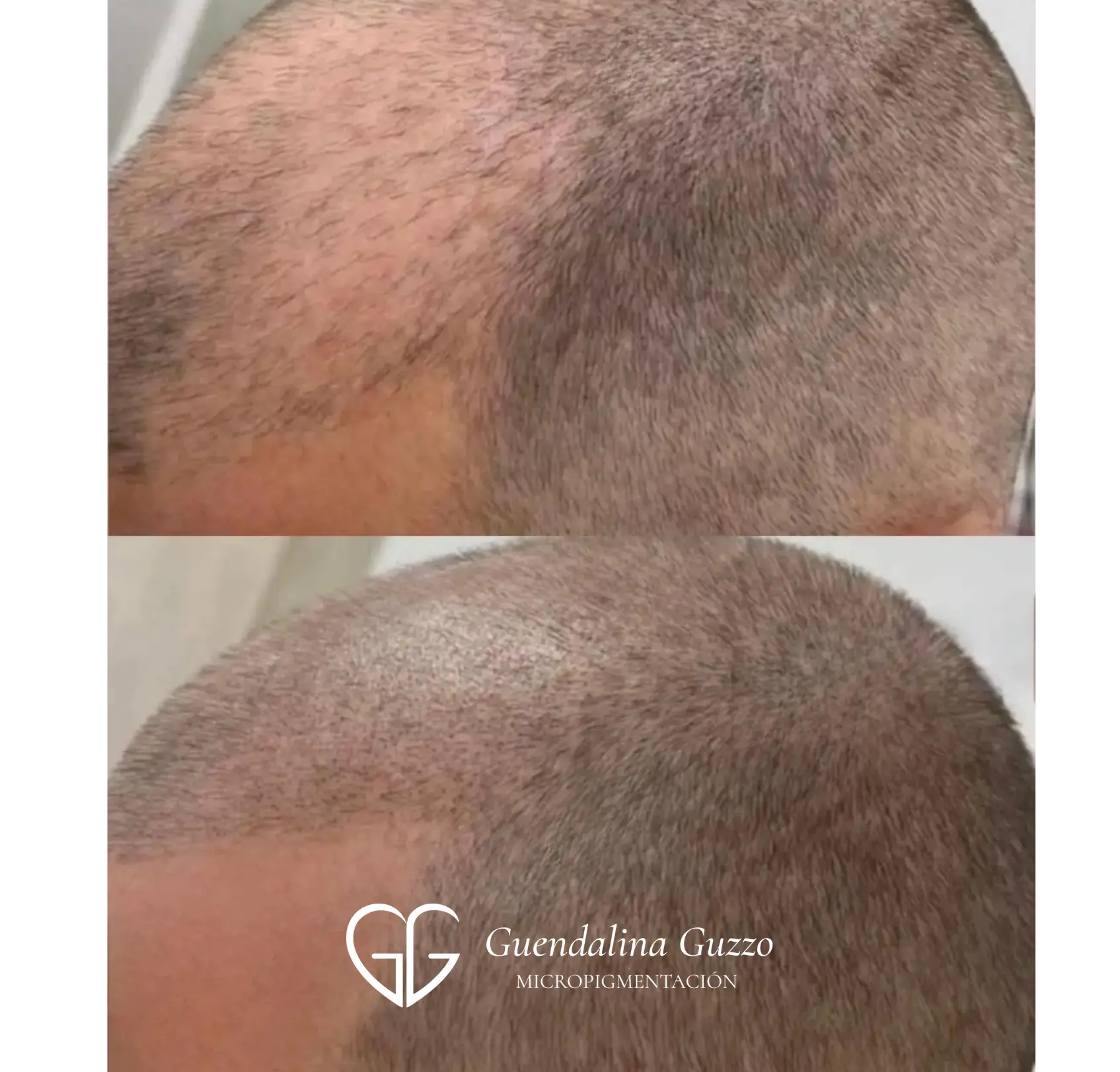 Resultado de micropigmentación capilar efecto densidad y rapado en hombre antes y después en Marbella por Guendalina Guzzo.