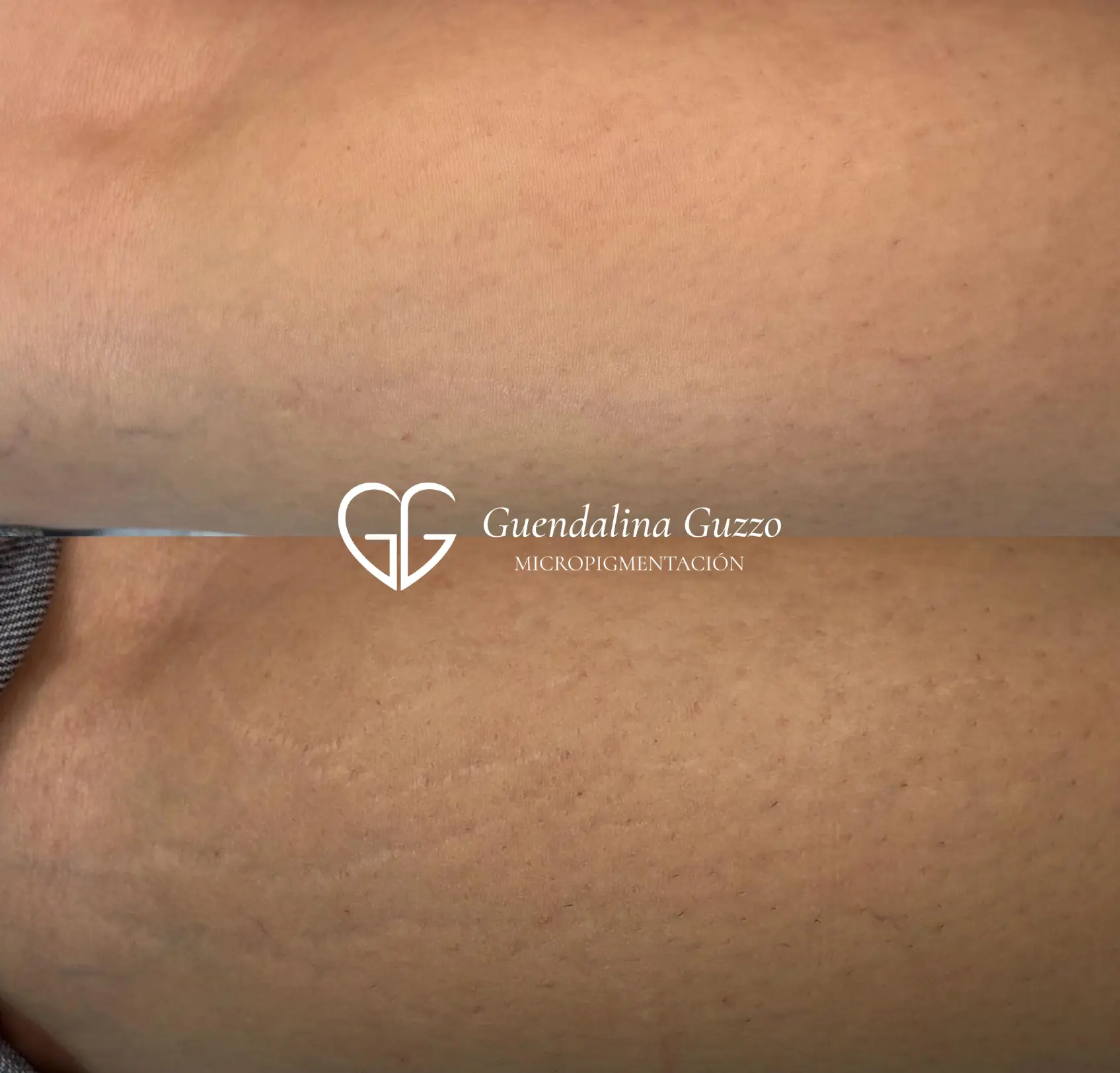 Resultado de antes y después del tratamiento de micropuntura brasileña para eliminar estrías en la piel. realizado por Guendalina guzzo en Marbella.
