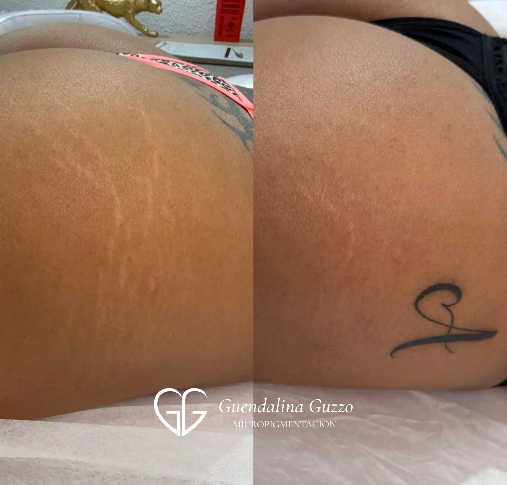 Resultado de antes y después de tratamiento para camuflaje y mejora de estrías en glúteos en Marbella por Guendalina Guzzo.